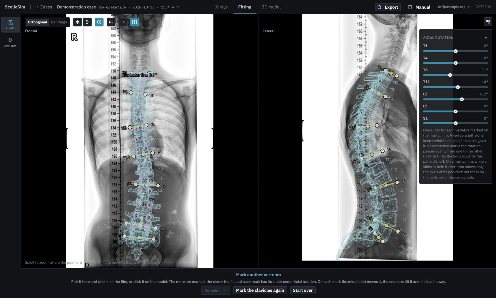 Pantalla de ajuste de ScolioSim: el modelo vertebral superpuesto a una radiografía frontal y a una lateral de la misma columna