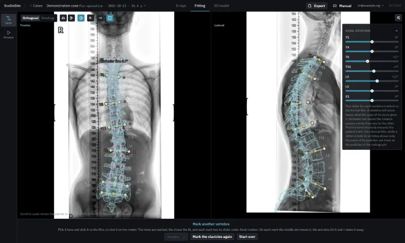 ScolioSim fitting screen: the vertebral model laid over a frontal and a lateral radiograph of the same spine