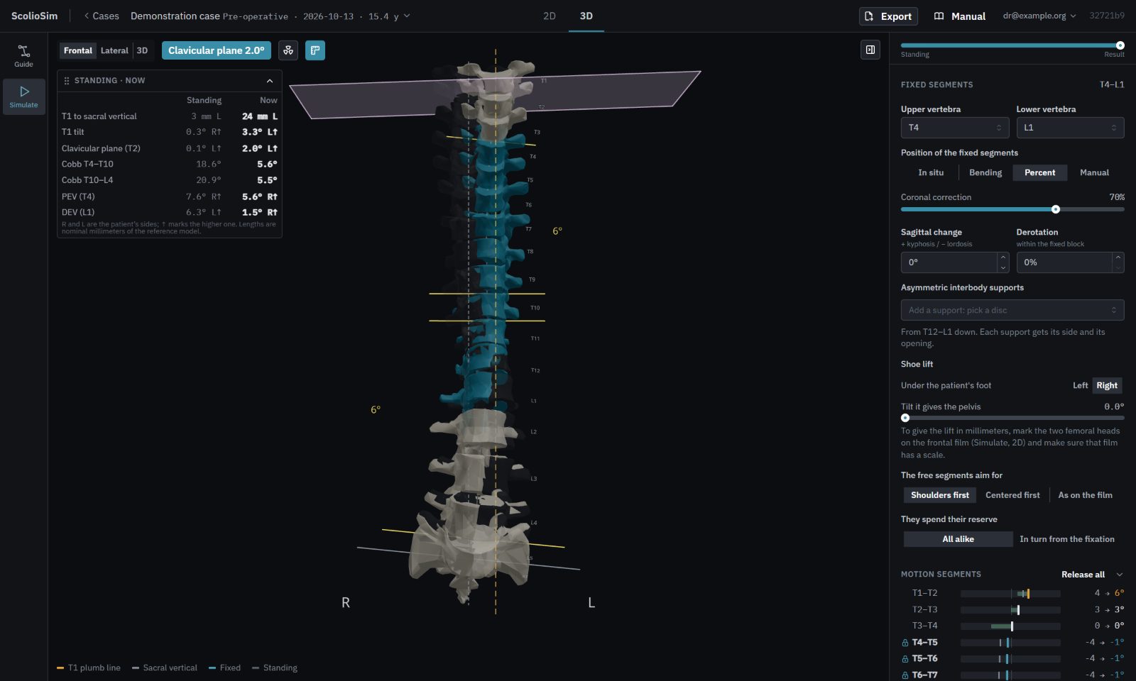Simulación 3D de ScolioSim: una fijación de T4 a L1 con la columna antes y después, líneas de referencia y ángulos de Cobb